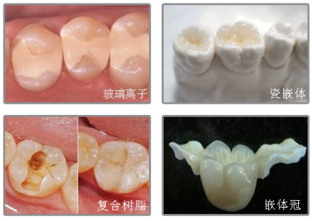 西安补牙多少钱