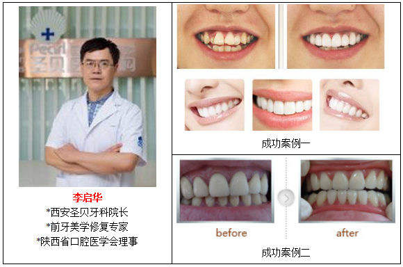 牙齿矫正哪种方法好