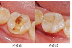 补牙要多少钱